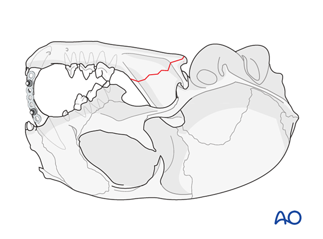 Elastic therapy for Mandible - Fractures of the ramus