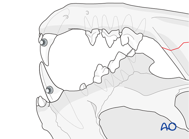 Elastic therapy for Mandible - Fractures of the ramus