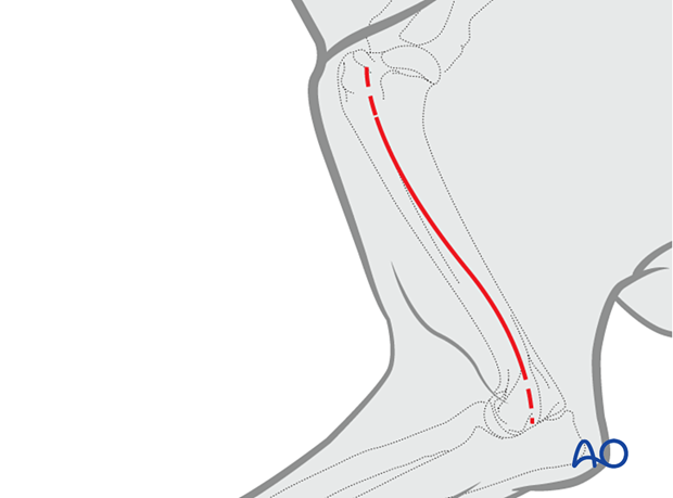 For more distal fractures, two separate approaches are required