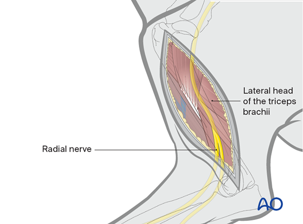 Subcutaneous fat and fascia are incised following the same incision