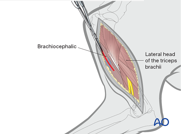 Fat and brachial fascia is incised and dissected away