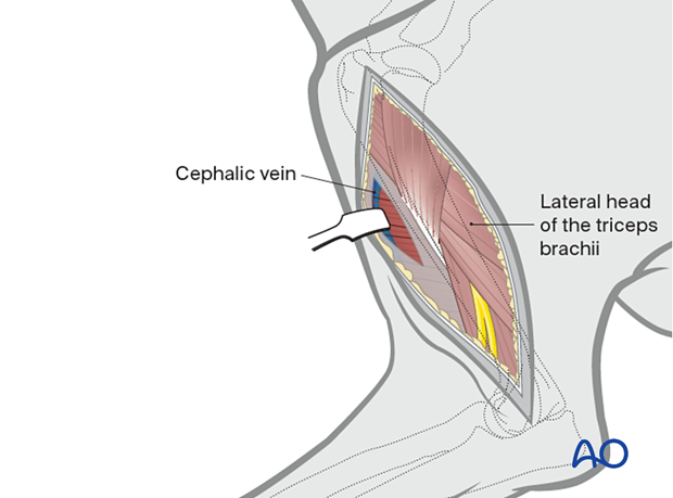 The cephalic vein can be dissected and moved cranially or caudally for visualization