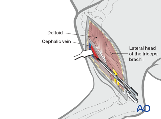 The craniomedial fascia and the insertion of the lateral head of the triceps brachii on the humerus can be dissected and separated