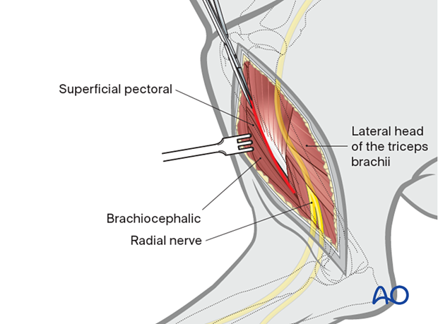 The periosteal insertion of the superficial pectoral and brachiocephalic muscles on the humeral shaft can be incised for greater exposure