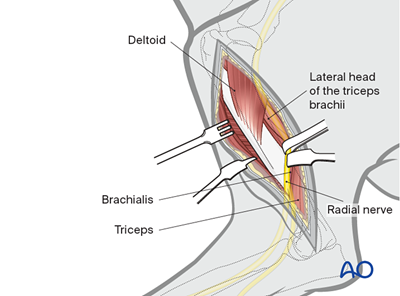 Lateral approach to the dog humeral shaft