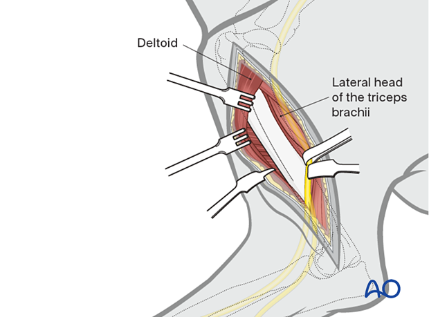 approach to the le fort i level of the midface in cleft lip and palate patients