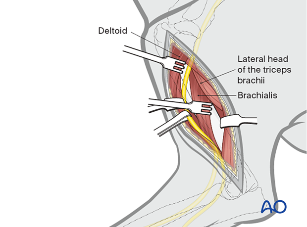 Radial nerve neurapraxia