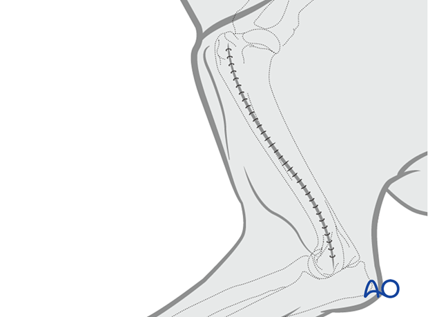 For proximal fractures, the lateral approach is extended cranially