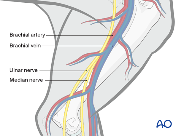 A bundle of vascular structures and nerves on the distal medial humerus should be protected during the approach