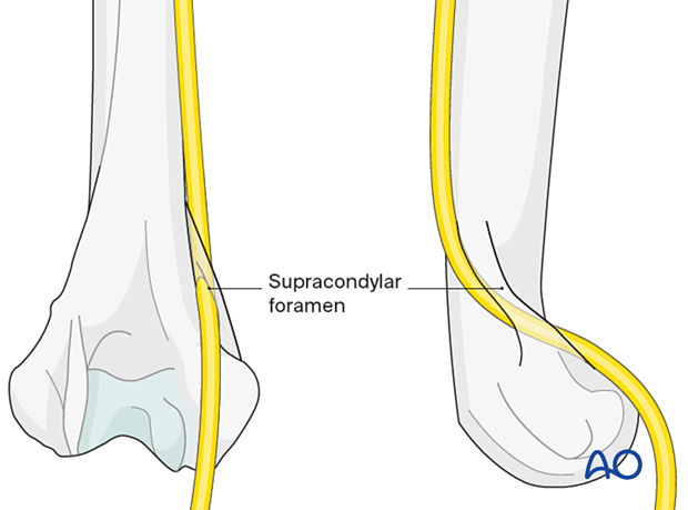 The median nerve cannot be moved freely in cats since it runs through the supracondylar foramen