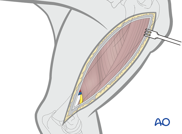 Subcutaneous fat and fascia are incised