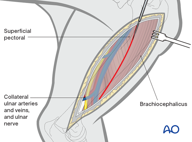 The deep brachial fascia is incised along the caudal border of the brachiocephalic muscle and the distal border of the superficial pectoral muscle