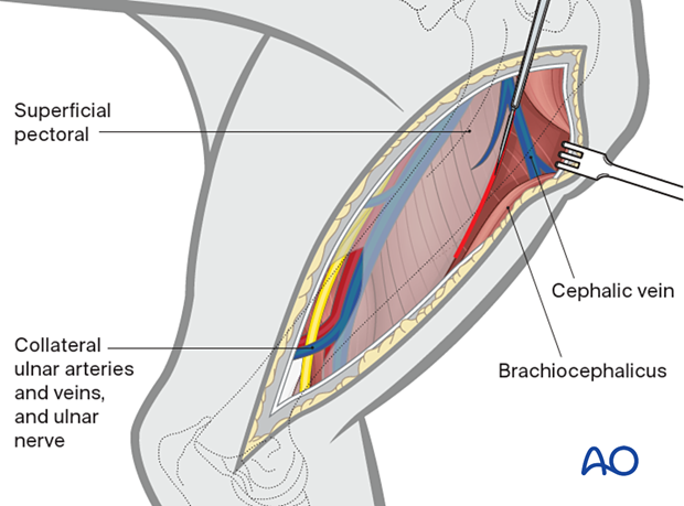 The brachiocephalic muscle is retraced cranially to expose the insertion of the superficial pectoral muscle