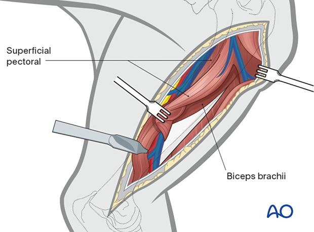 The biceps brachii muscle is retracted caudally, and the proximal brachiocephalic muscle is retracted cranially