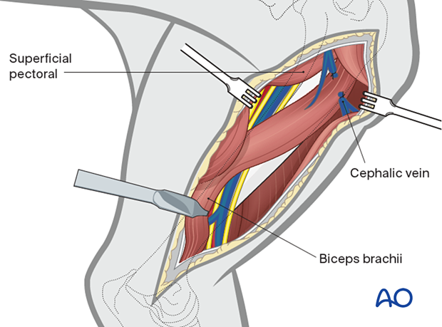 The remaining attached part of the superficial pectoral muscle is retracted as needed for plate application