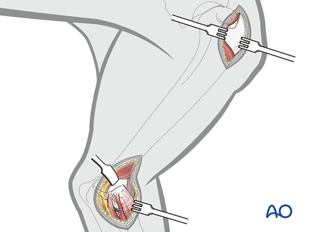 approach to the le fort i level of the midface in cleft lip and palate patients