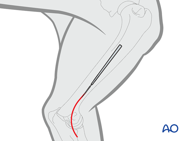 The distal skin incision is centered over the caudal aspect of the medial epicondyle