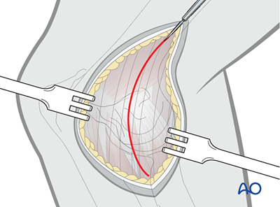 Minimally invasive approach to the dog humeral shaft