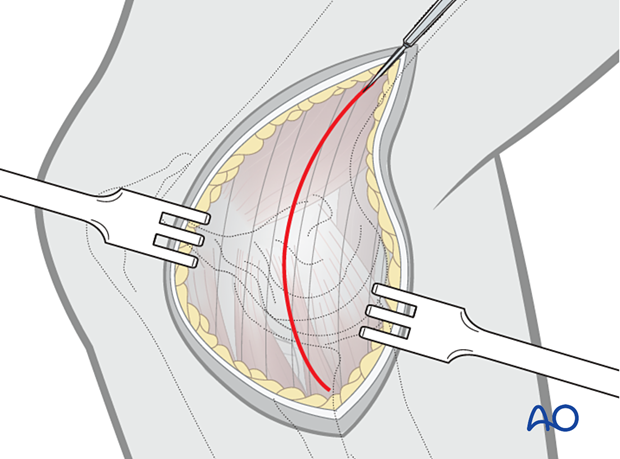 The caudal and distal aspects of the medial epicondyle are exposed