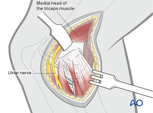 The ulnar nerve and the medial head of the triceps muscle are retracted caudally and mobilized