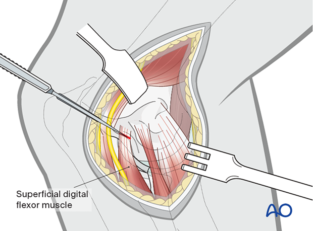 For intramedullary pin insertion, the distal edge of the bone is exposed by partially transecting the origin of the superficial digital flexor muscle on the medial epicondylar ridge