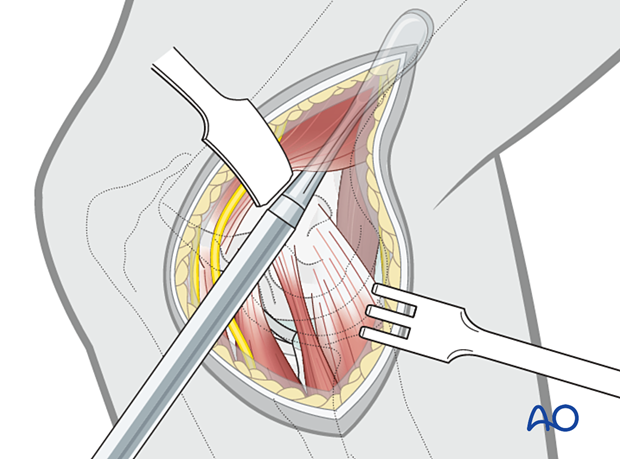 For plate application, an epiperiosteal tunnel is made