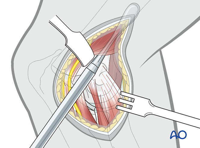 Minimally invasive approach to the dog humeral shaft