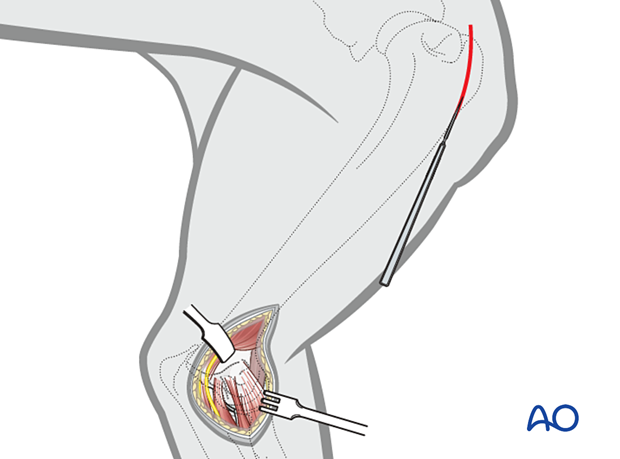 Proximally the skin is incised over the craniomedial aspect of the humerus