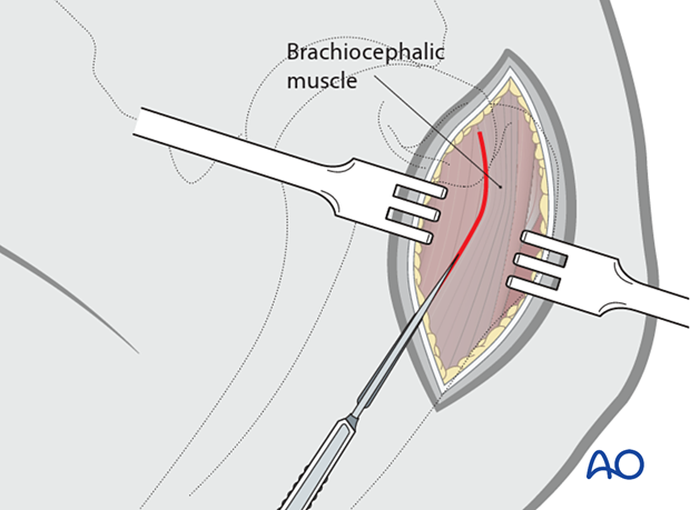 The subcutaneous fat and fascia are incised along the brachiocephalic muscle