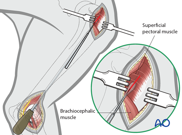 The muscle or fascia is incised over the instrument to complete the tunnel