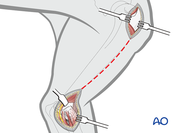 The medial aspect of the humerus can be entirely exposed by extending the minimally invasive approach