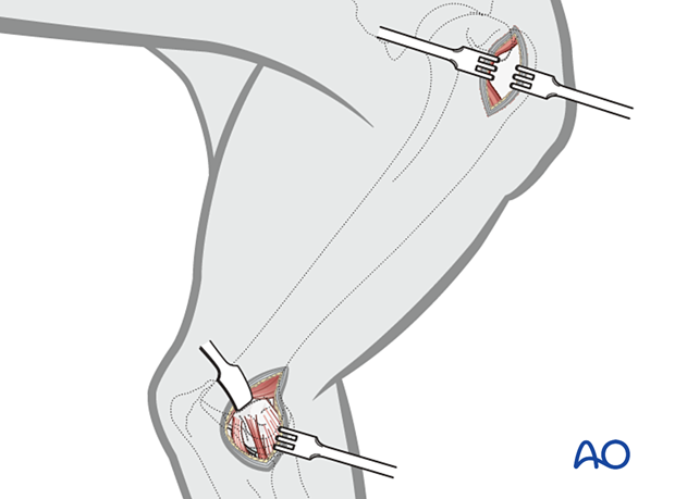 Once familiar with this approach, the proximal and distal incisions can be reduced in size