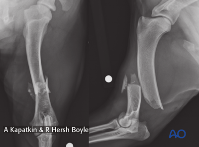 Dog humeral diaphyseal fracture with several reducible wedge