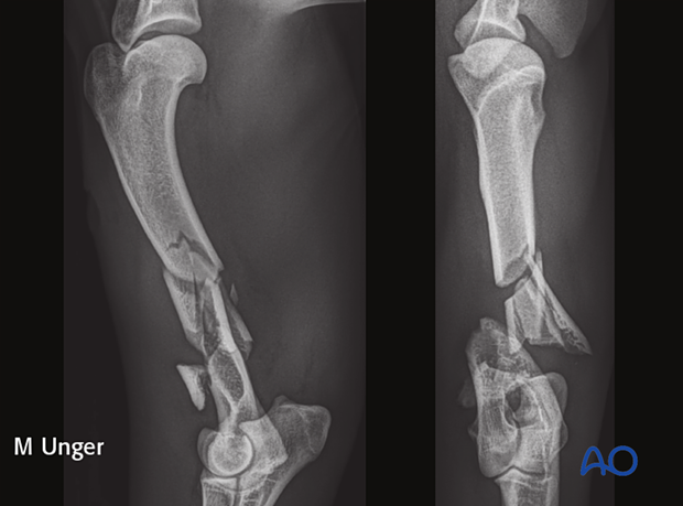 Lateral and AP x-ray of a multifragmentary humeral shaft fracture in the dog