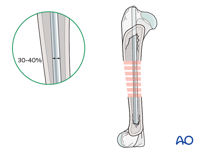 Bridging plate and pin for Dog humeral diaphyseal fracture with complex ...