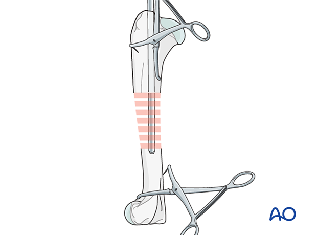 Fracture reduction