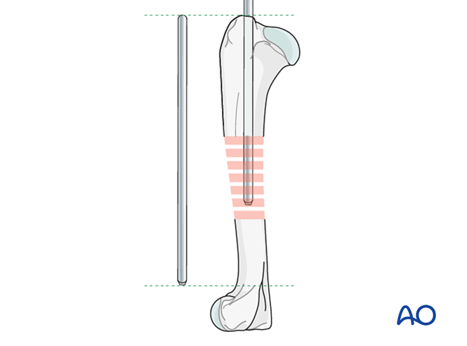 Bridging plate and pin for Dog humeral diaphyseal fracture with complex ...