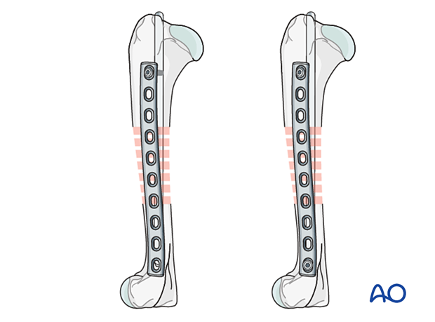 Plate fixation