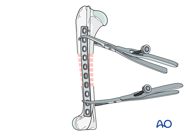 Securing plate with bone clamps