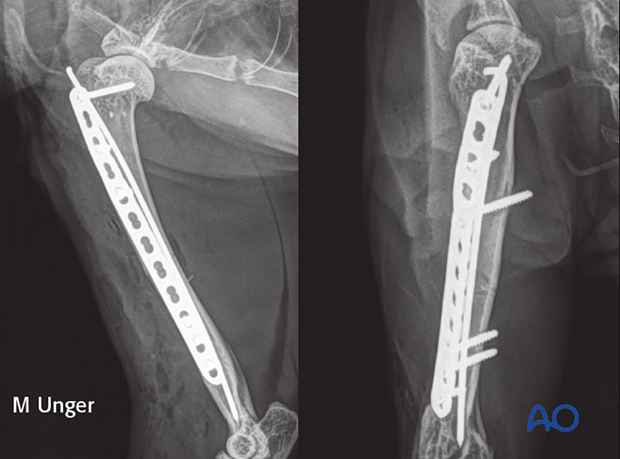 Postoperative radiographs