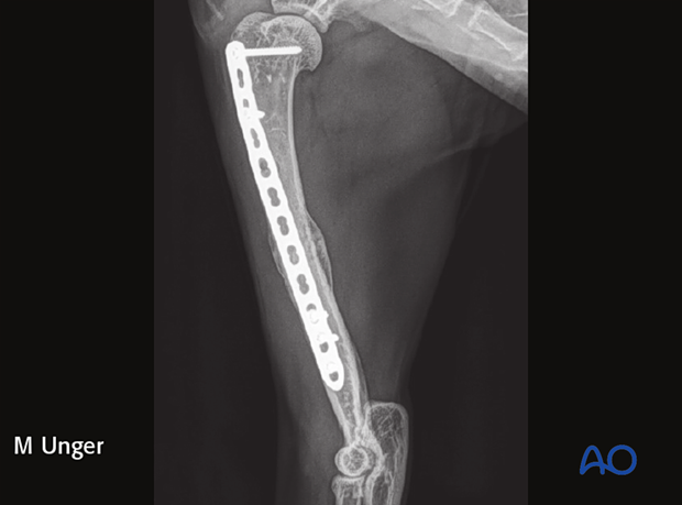 Follow-up radiographs at 9 months