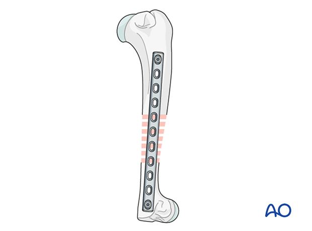 Plate fixed to bone with one screw in each fragment