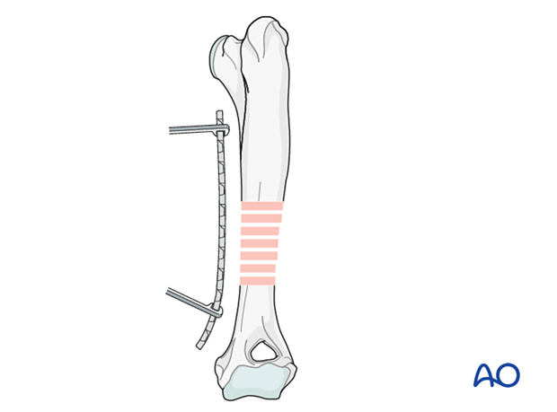 approach to the le fort i level of the midface in cleft lip and palate patients