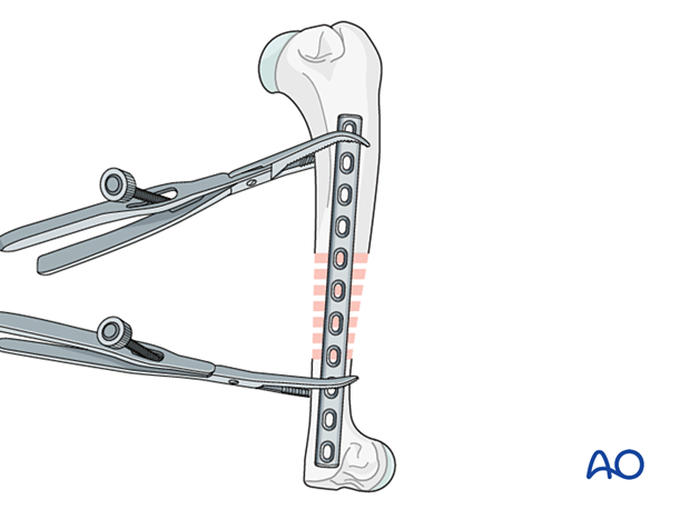 Plate secured with bone holding forceps