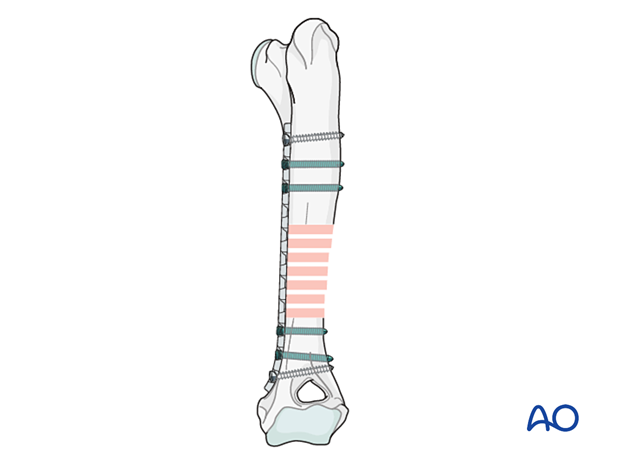 approach to the le fort i level of the midface in cleft lip and palate patients