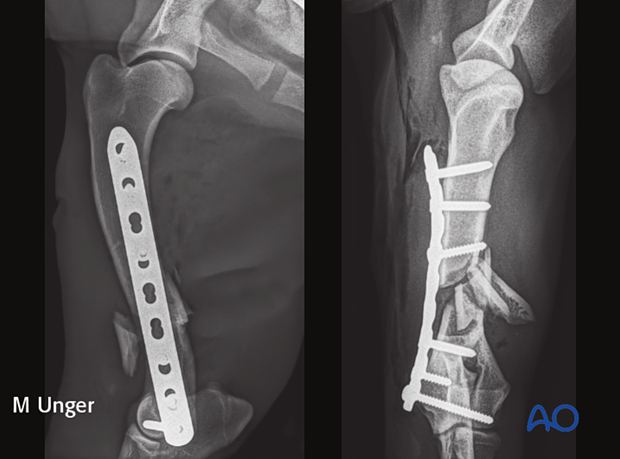 Postoperative radiographs