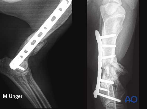 Follow-up radiographs at six months