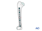 Compression plate
