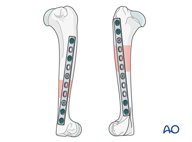 D12_P030_i120 Plate application to lateral or medial side