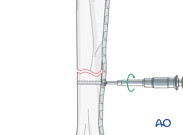 D12_P030_i140_A3 The first screw is inserted in compression mode